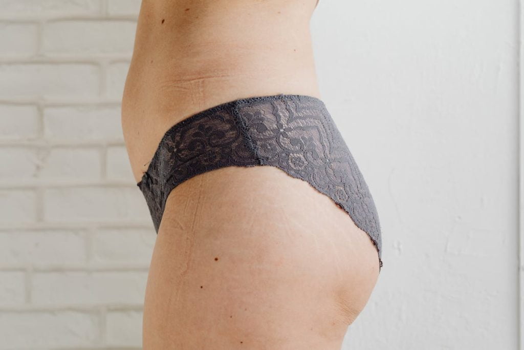 tratamiento eliminar estrias